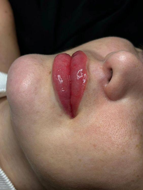 Pigmentación de labios — resultado